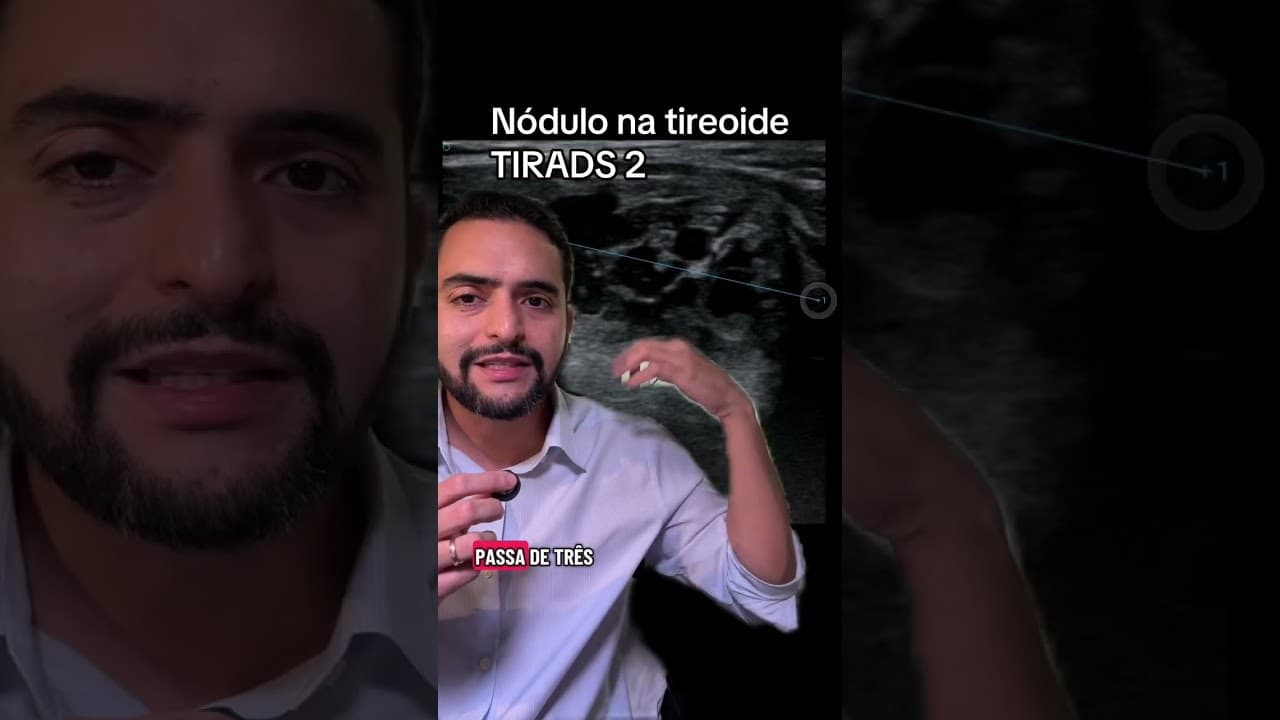 TIRADS 2 no ultrassom: o que significa e o que é nódulo espongiforme