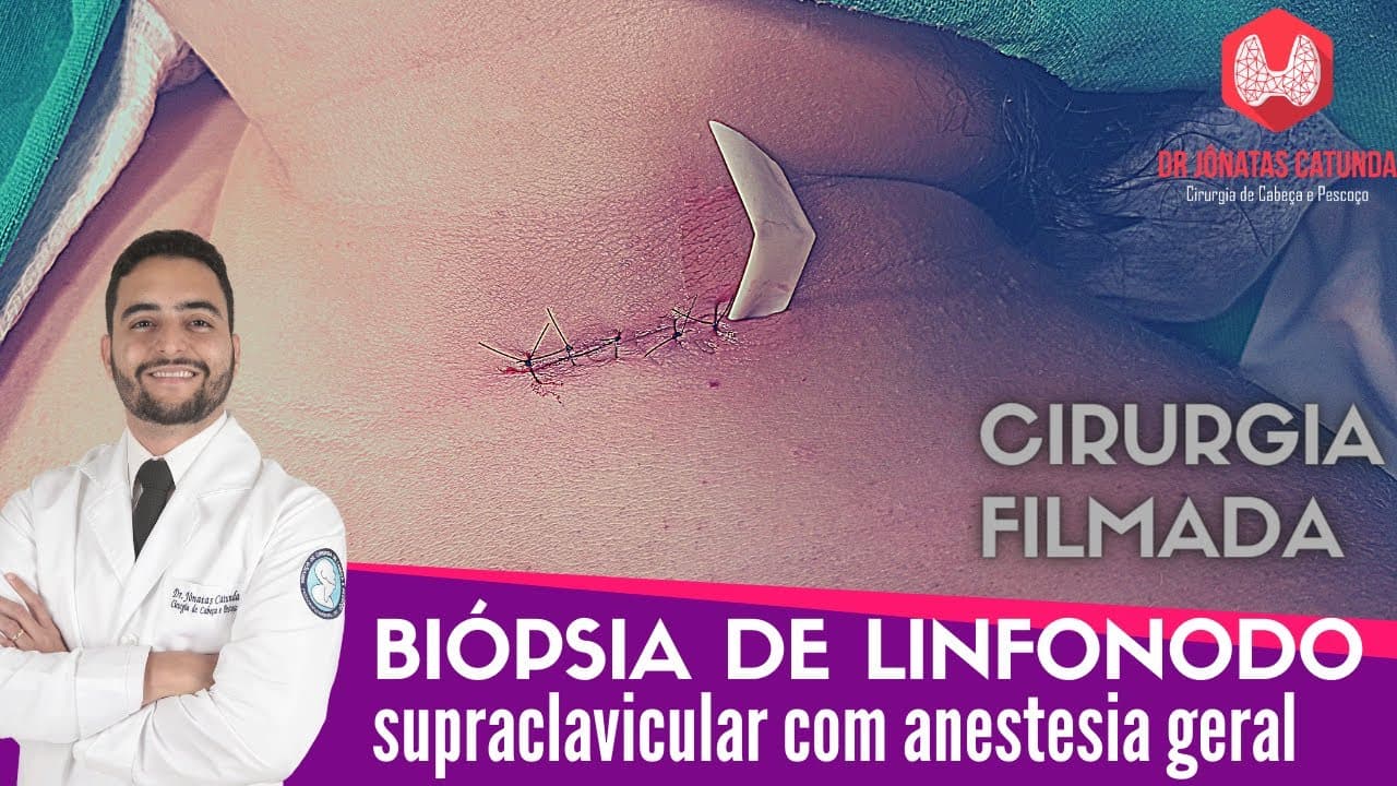 Biopsia de linfonodo supraclavicular com anestesia geral - Cirurgia filmada