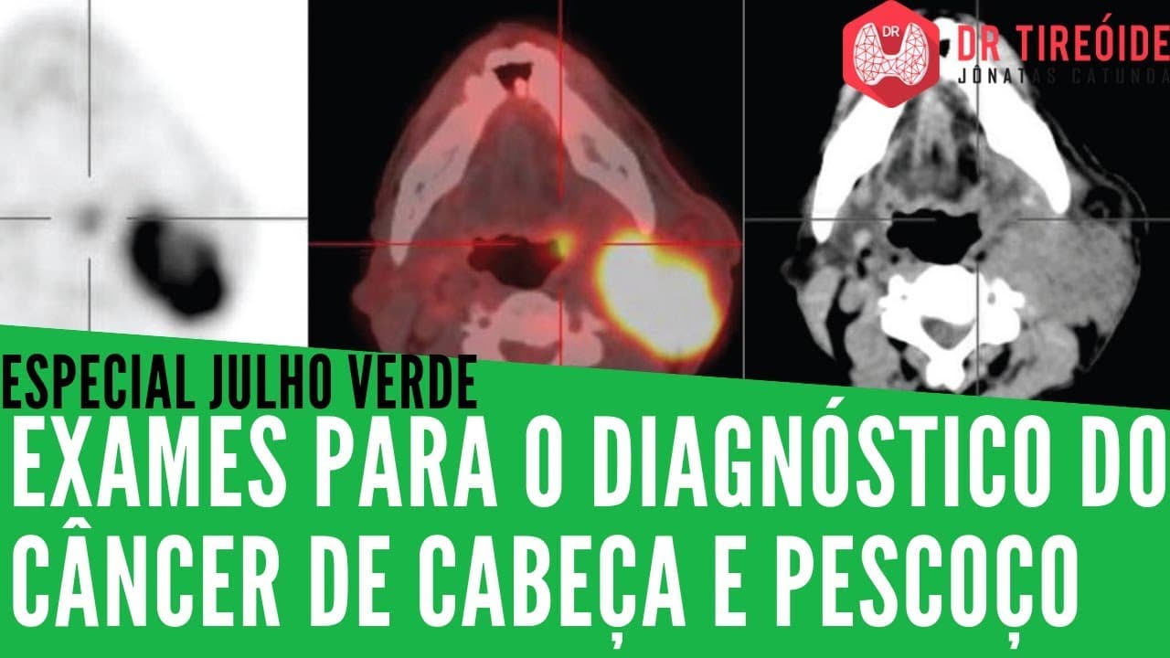 Julho Verde - Exames para o diagnóstico do Câncer de Cabeça e Pescoço