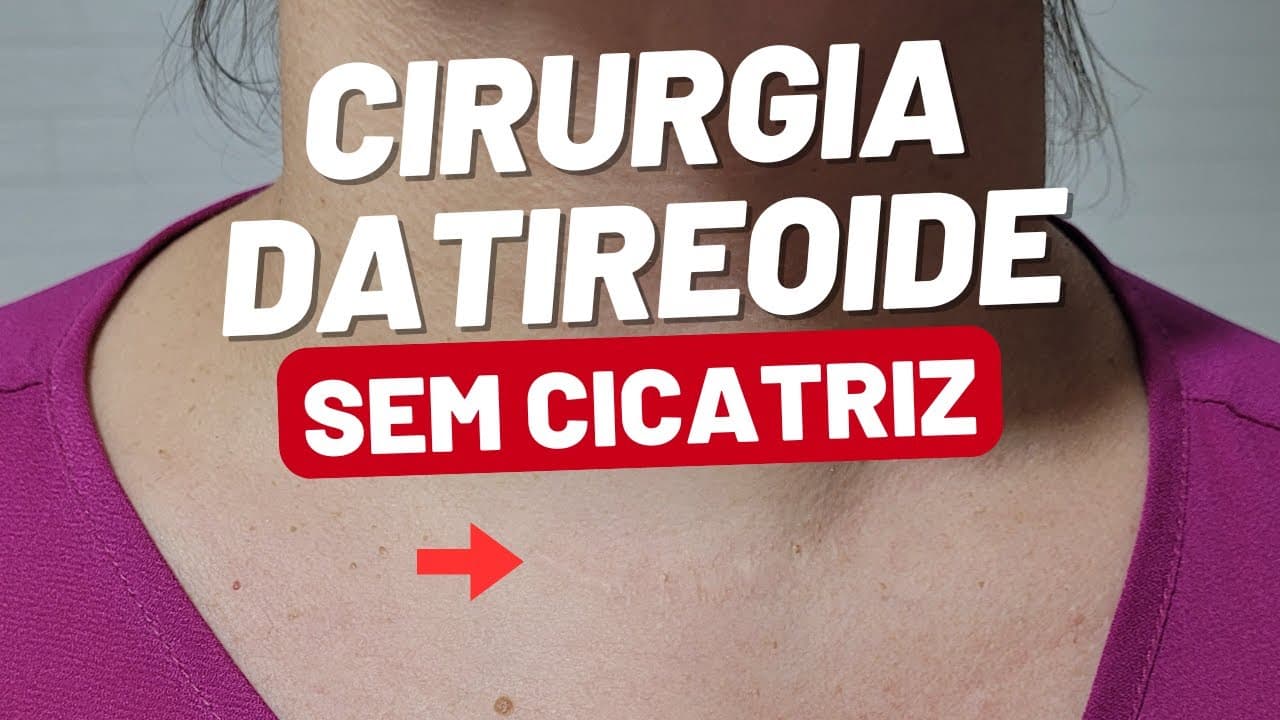 CIRUGIA ROBOTICA DA TIREOIDE EM 2025