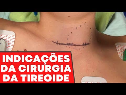 Principais indicações de cirurgia para nódulo na tireoide