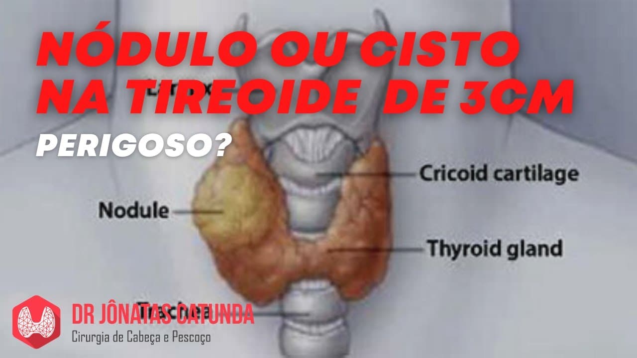 Nódulo ou cisto na tireoide de 3cm - é preocupante? Cirurgia? Medicamento?