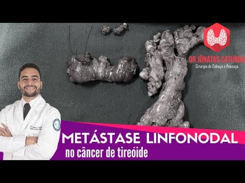 Metástase para os linfonodos no câncer de tireóide