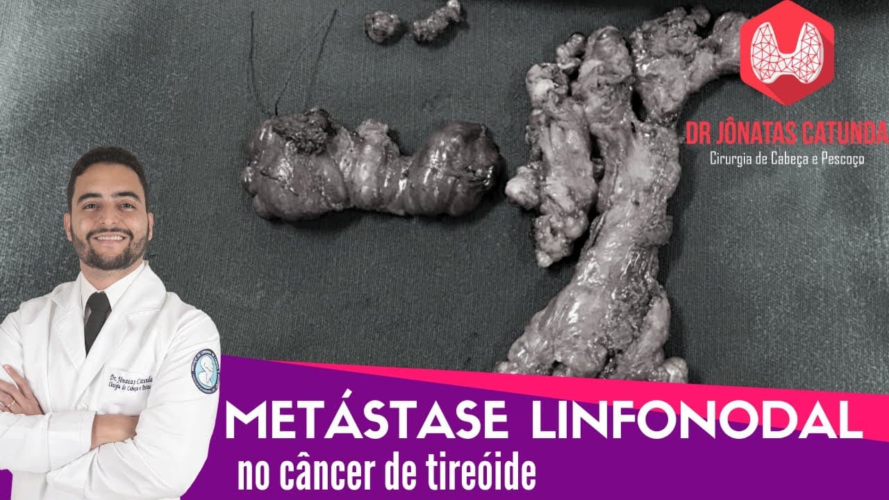 Metástase para os linfonodos no câncer de tireóide
