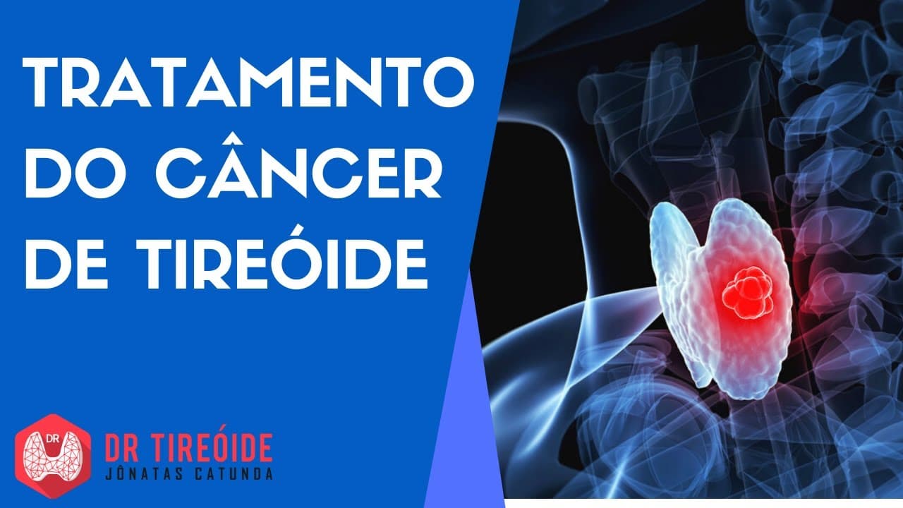 Tratamento do Câncer de Tireóide - Dr Tireóide responde