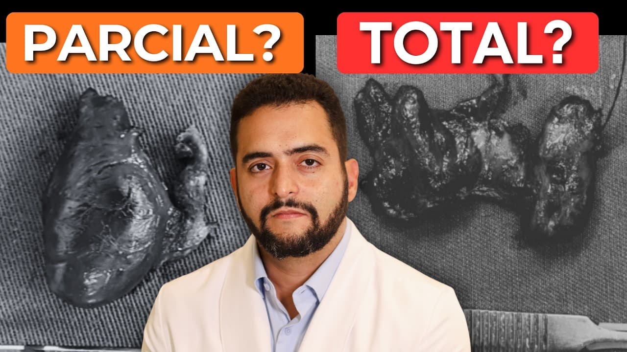 Cirurgia parcial ou total da tireoide? Como decidir no nódulo suspeito