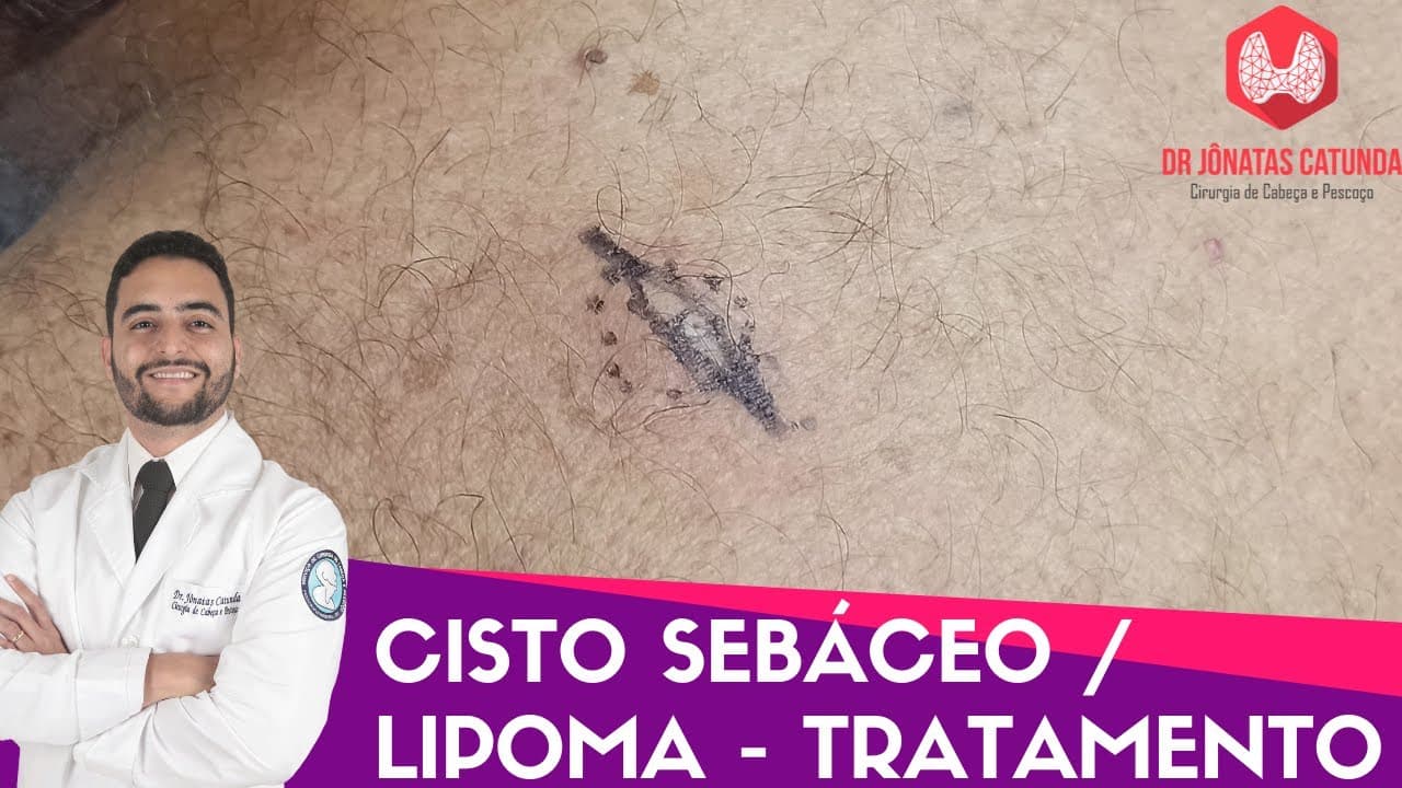 Cisto sebáceo / Lipoma: tratamento
