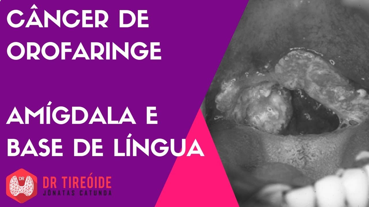Câncer de orofaringe - garganta, amígdala, base de língua
