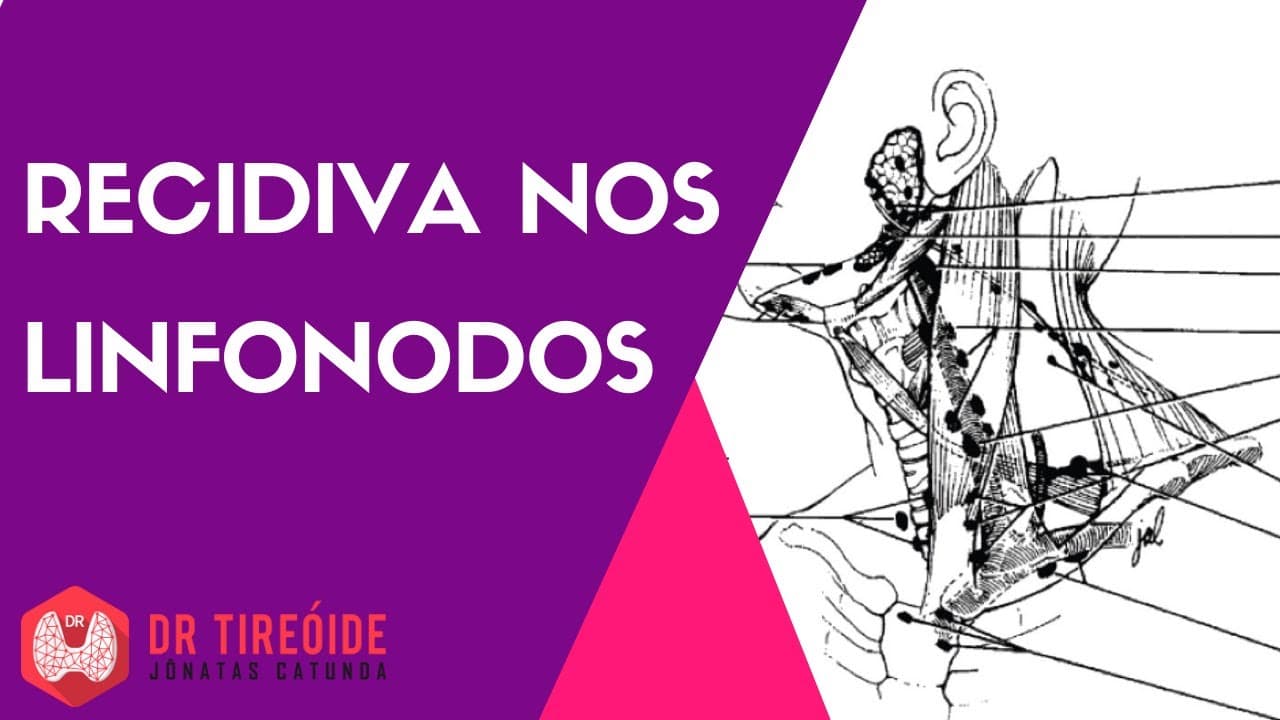 Recidiva nos linfonodos - Câncer de tireóide
