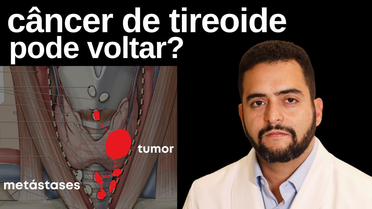 O Câncer de Tireoide Voltou — ou Nunca Foi Embora? Recidiva vs Persistência