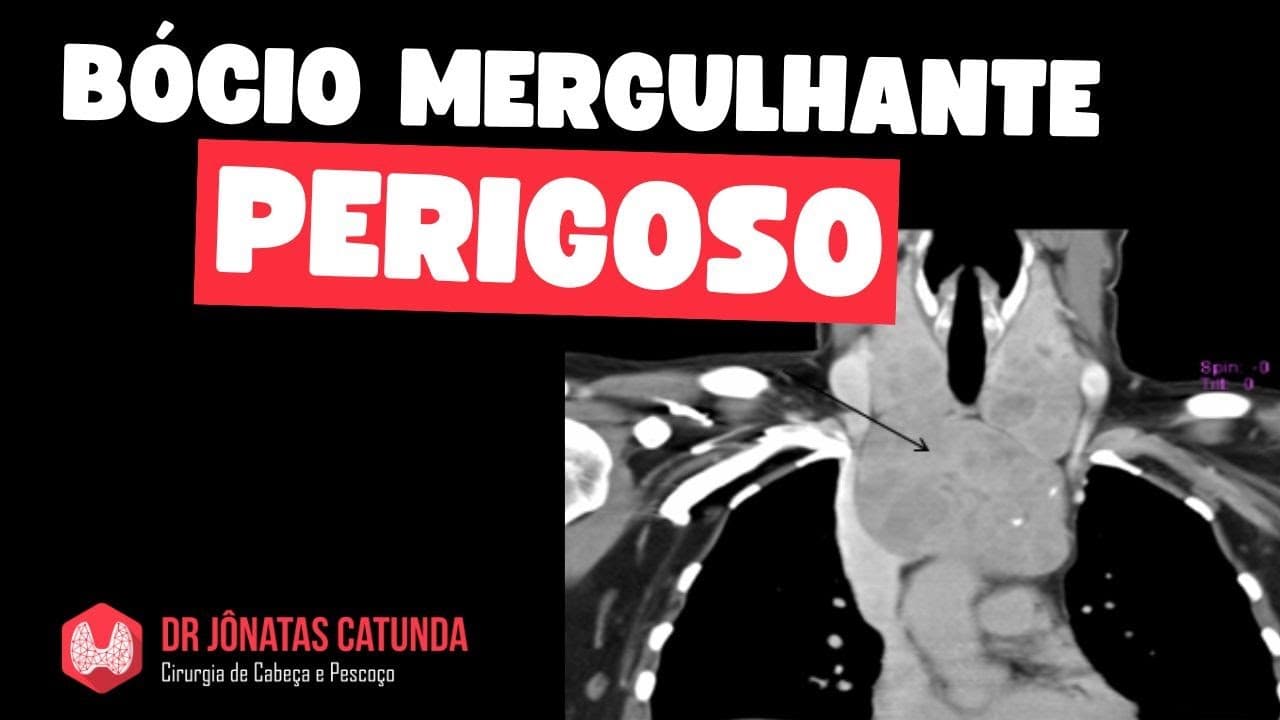 Bócio mergulhante perigoso / Câncer de seio piriforme / Nódulo na tireoide que regrediu