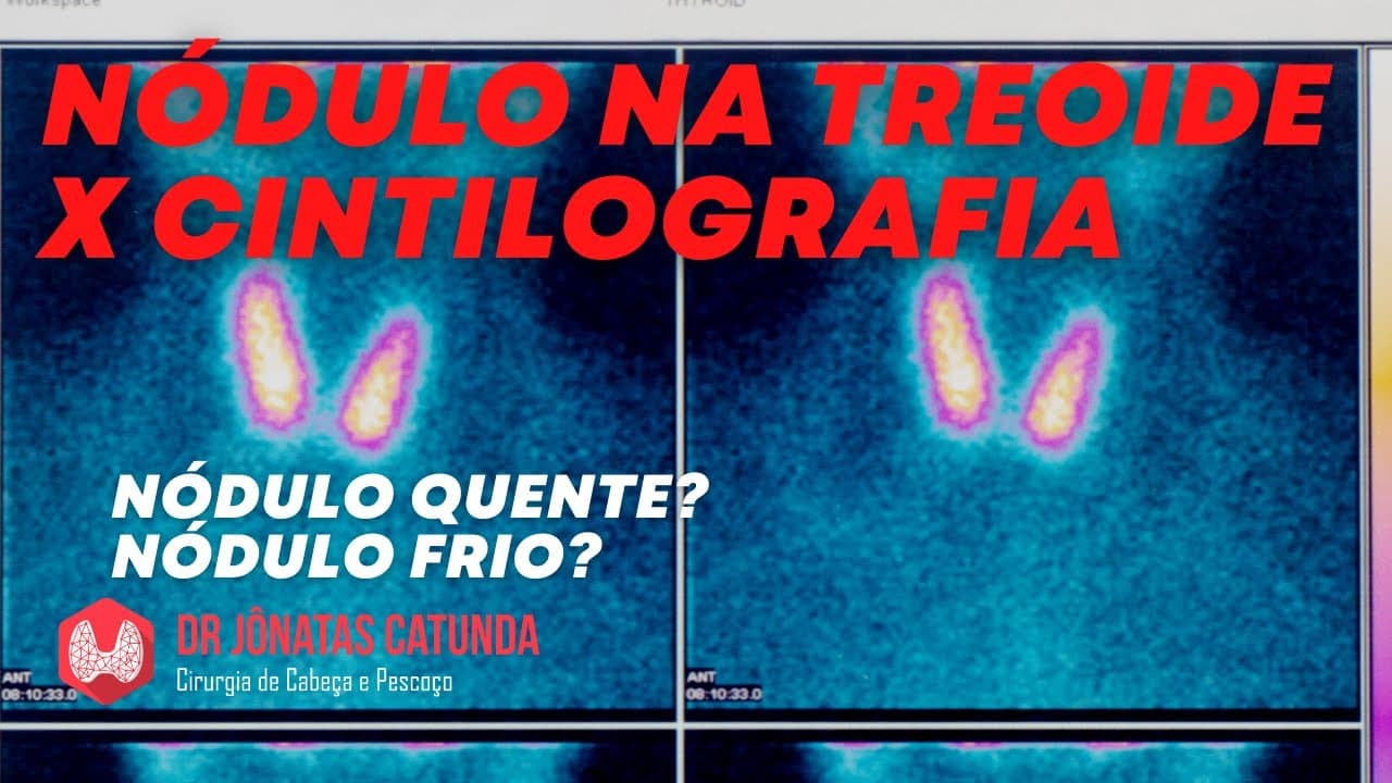 Cintilografia da tireoide - nódulos quentes e frios, qual a relação com o câncer?