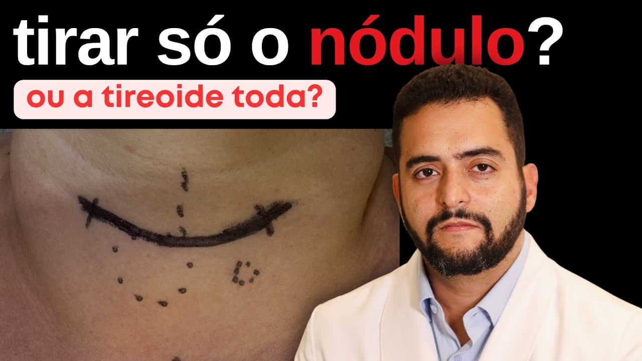 Câncer de Tireoide: dá para tirar só o nódulo?