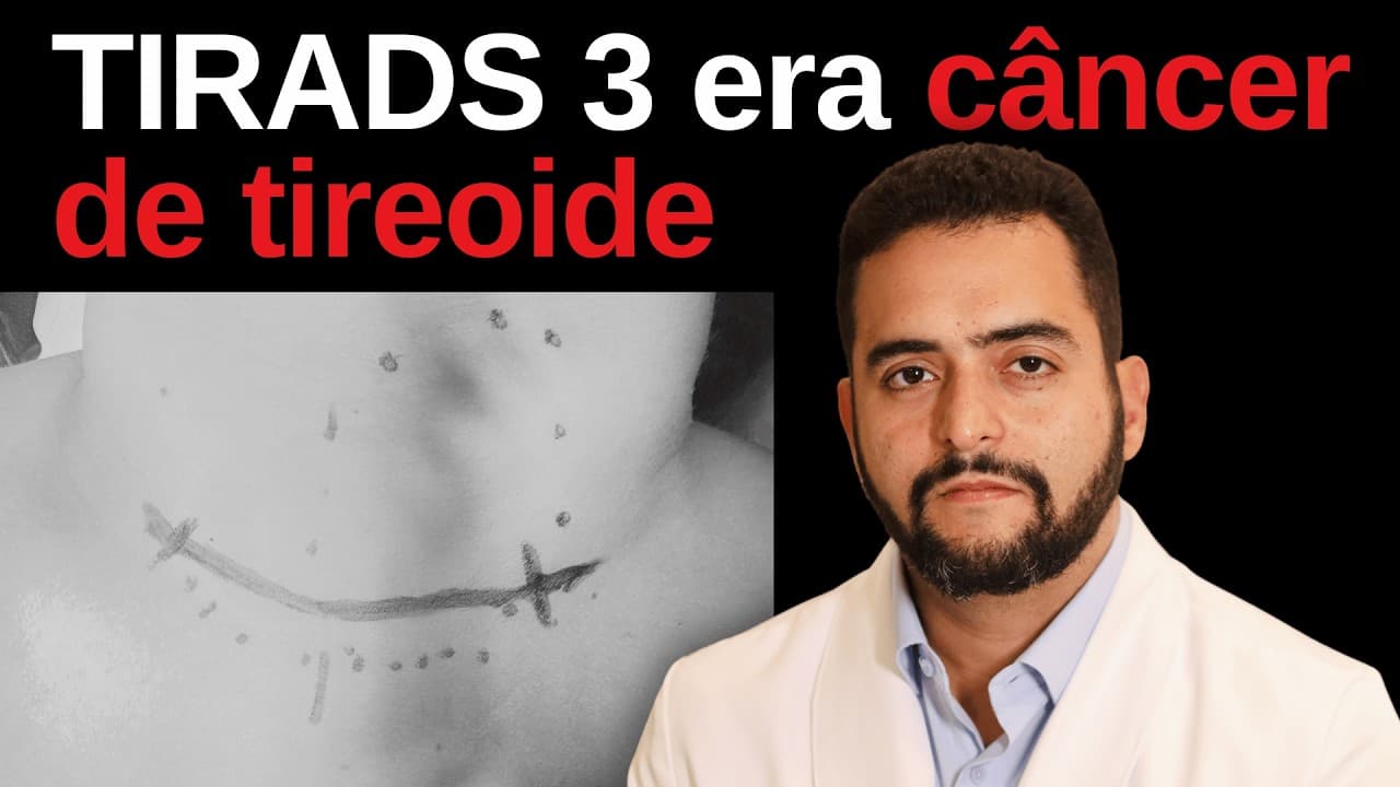 TIRADS 3 virou câncer com metástase: como isso é possível?