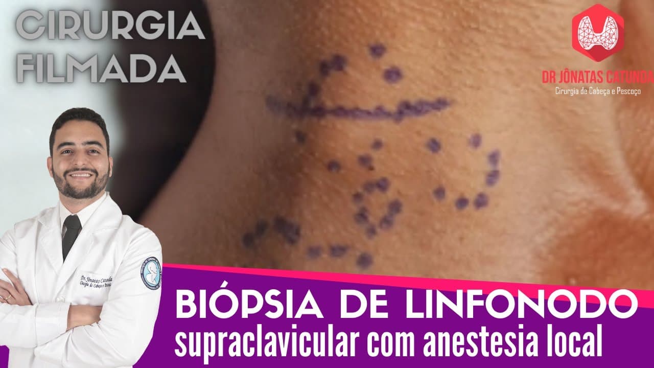 Biopsia de linfonodo supraclavicular com anestesia local - Cirurgia completa