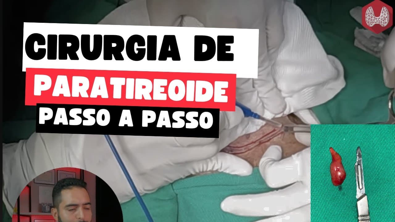 Cirurgia de paratireoide passo a passo: tratando o hiperparatireoidismo