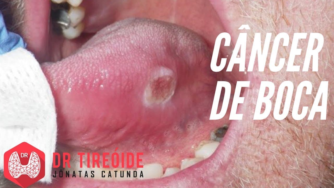 Câncer de boca - Sintomas, Diagnóstico, Tratamento e Prognóstico | Dr Jônatas Catunda
