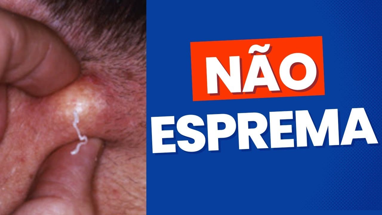 Cisto sebáceo (cisto de massa) - não esprema! Tratamento