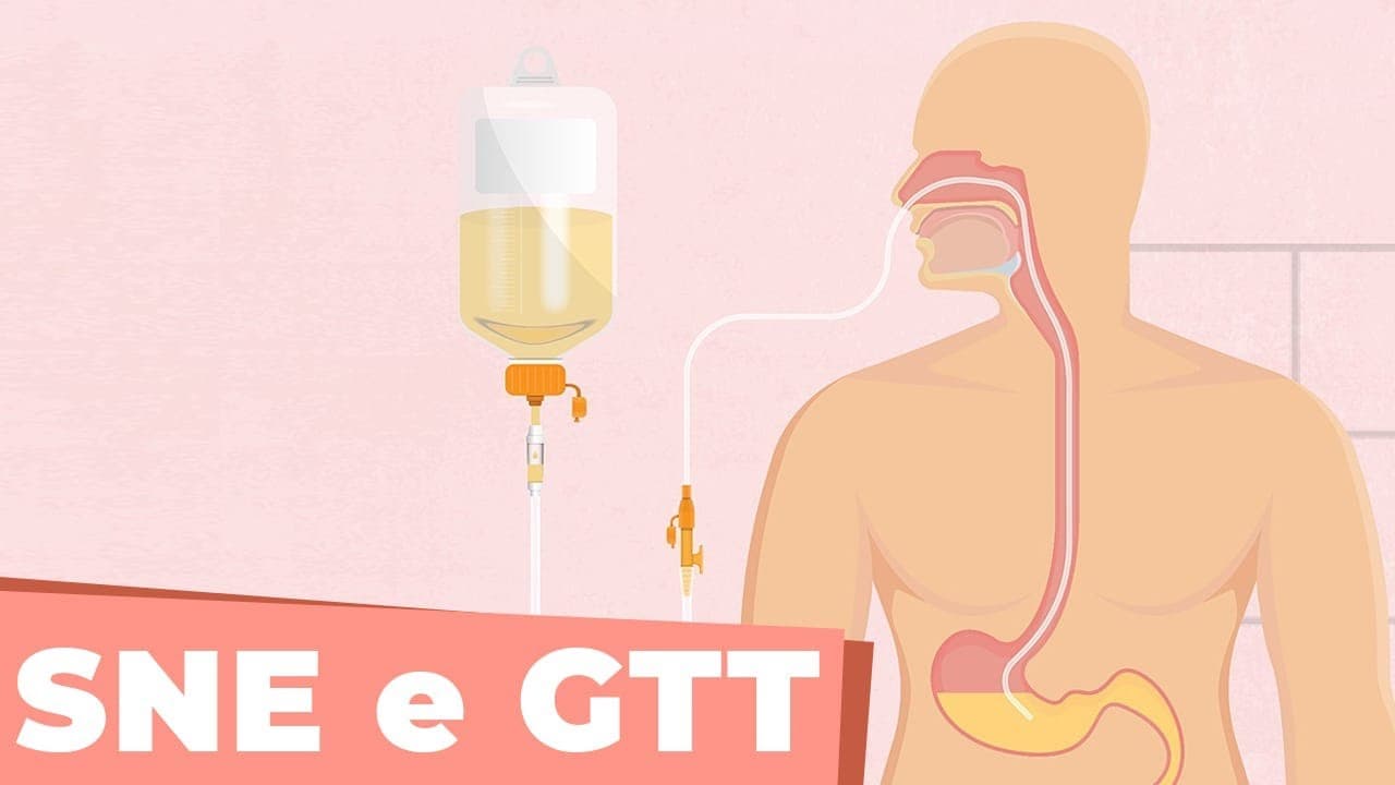 Sonda nasoenteral X Gastrostomia - Câncer de cabeça e pescoço