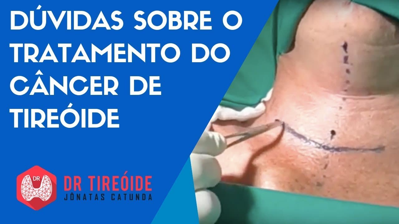 Dúvidas sobre o tratamento do câncer de tireóide | Dr Tireóide Responde