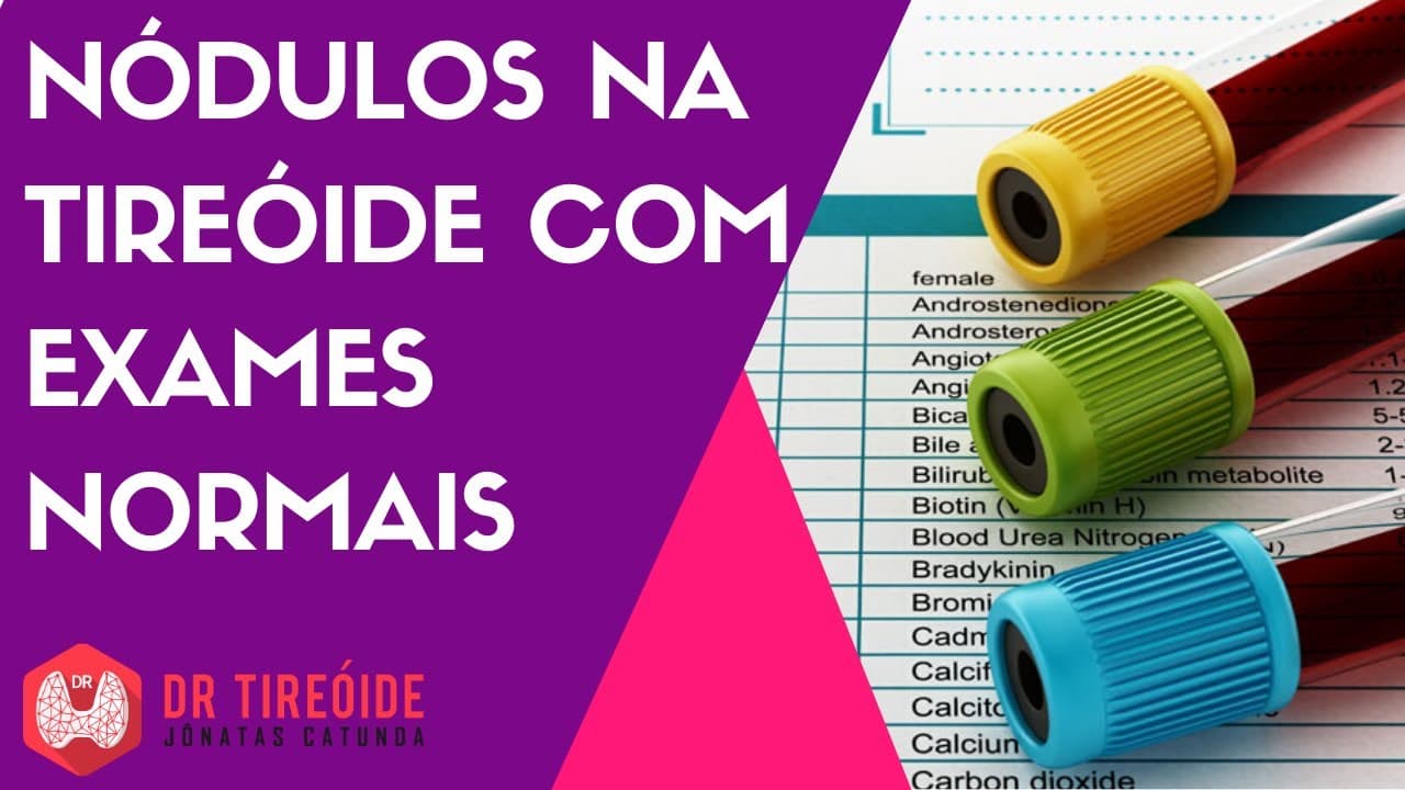 Nódulo na tireóide com exames normais | Dr Jônatas Catunda