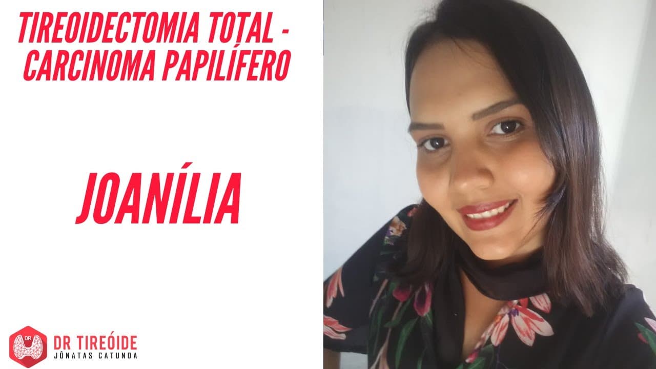 Tireoidectomia total por carcinoma papilífero - Depoimento Joanília - Tireóide e eu -
