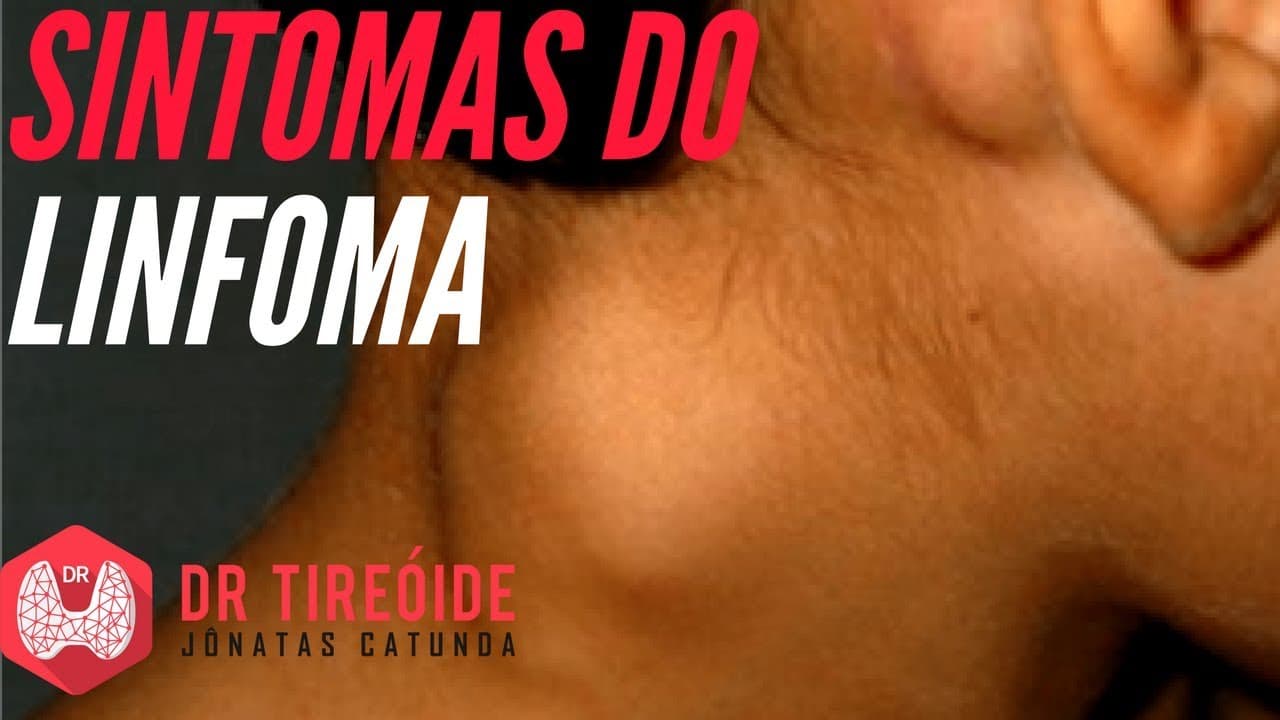 Linfoma: Entenda os sintomas! | Dr Jônatas Catunda