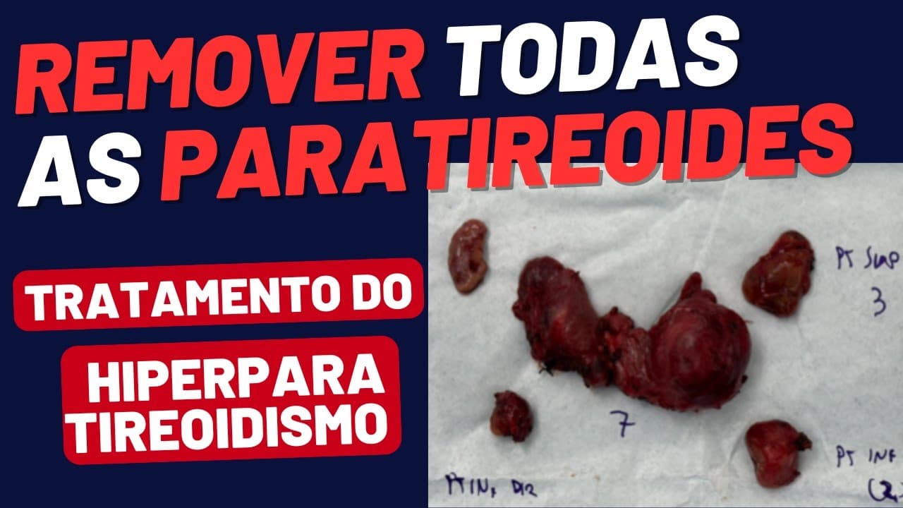 Retirada Total da Tireoide e das 4 Paratireoides: Como Fica a Saúde Depois da Cirurgia?