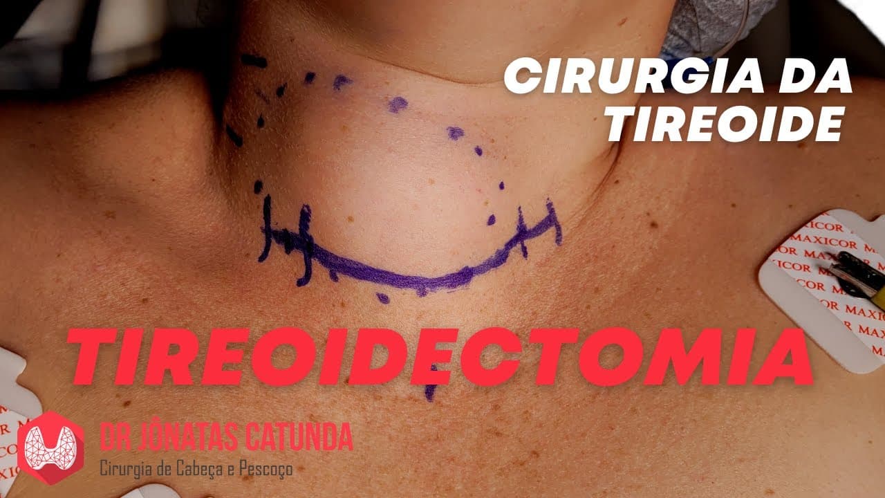 Dicas para quem vai passar pela cirurgia da tireoide - tireoidectomia