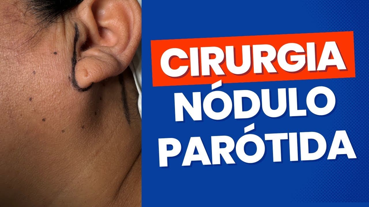 Nódulo na parótida - detalhes da cirurgia de parotidectomia