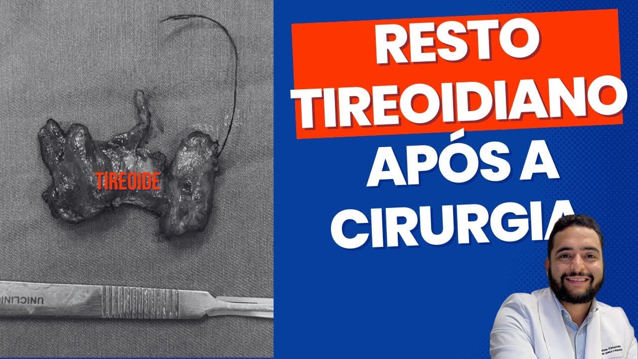 Resto tireoidiano após a cirurgia - causa tireoglobulina elevada