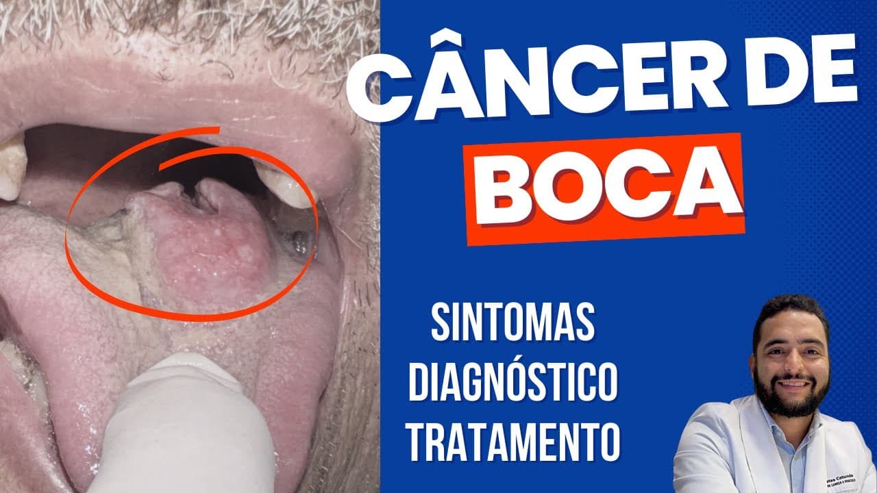 Câncer de boca - Sintomas, diagnóstico e tratamento