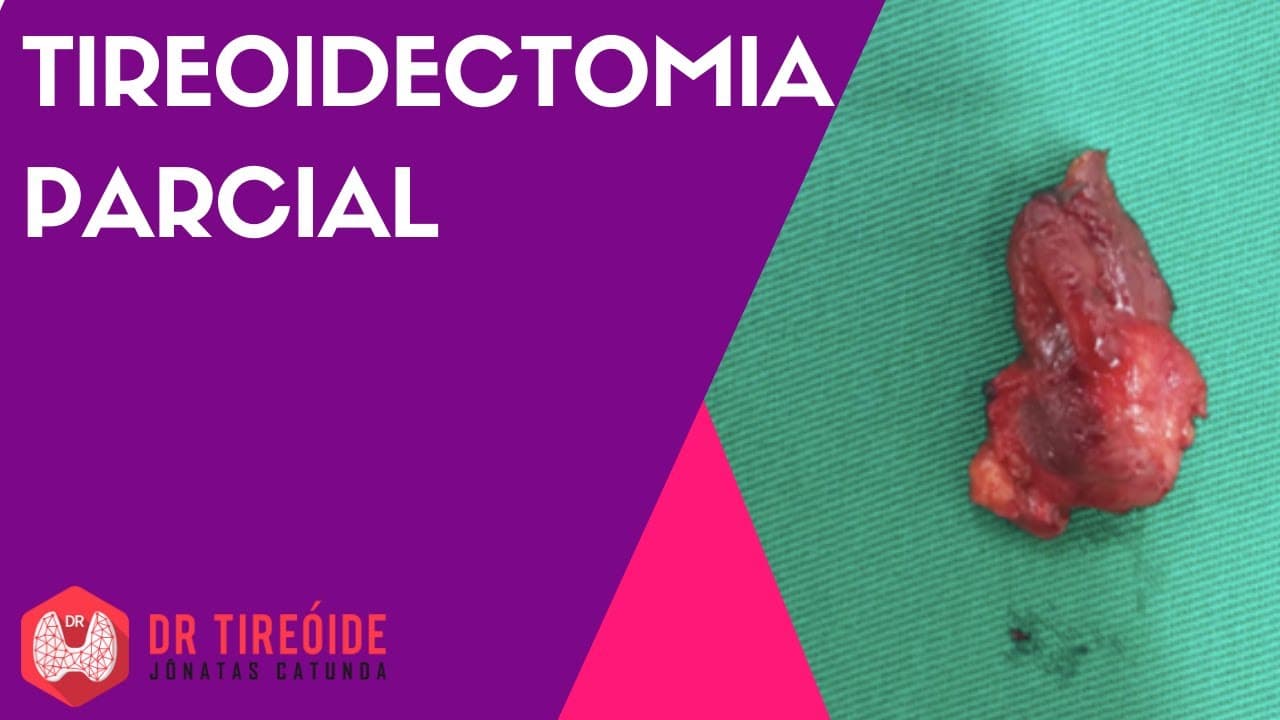 Tireoidectomia parcial