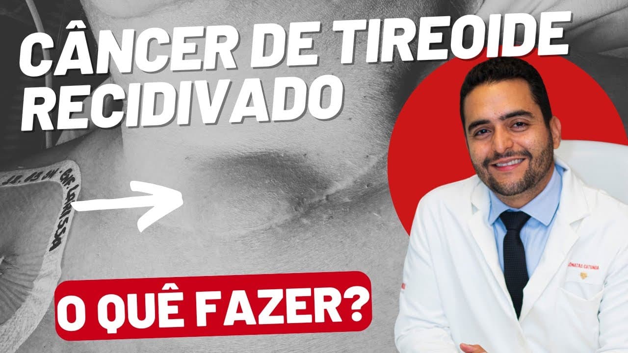 Câncer de Tireoide Recidivado: Opções de Tratamento e Acompanhamento