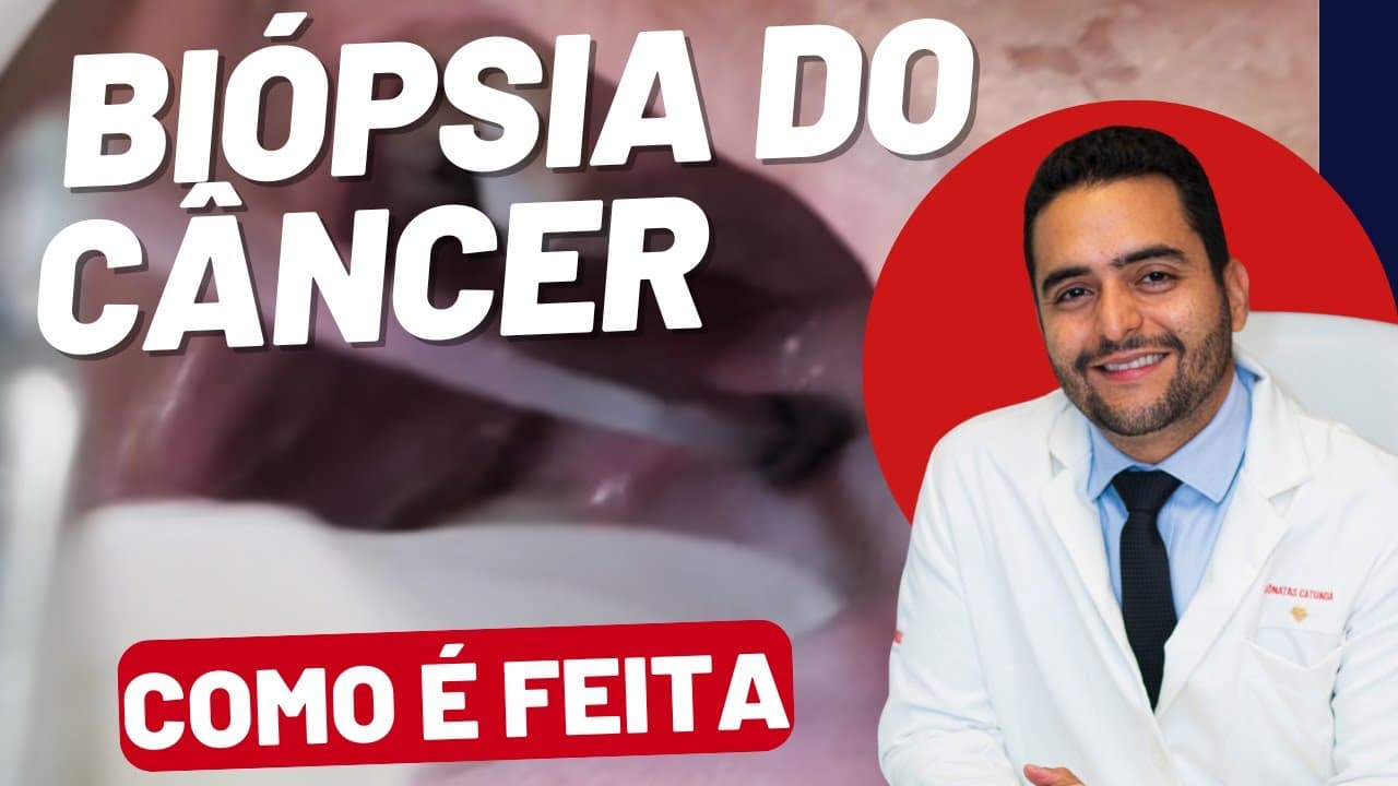 Biópsia do Câncer de Garganta: Veja como é feita