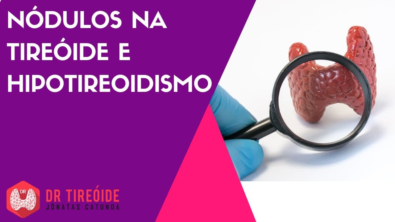 Nódulos na tireóide e hipotireoidismo | Dr Jônatas Catunda