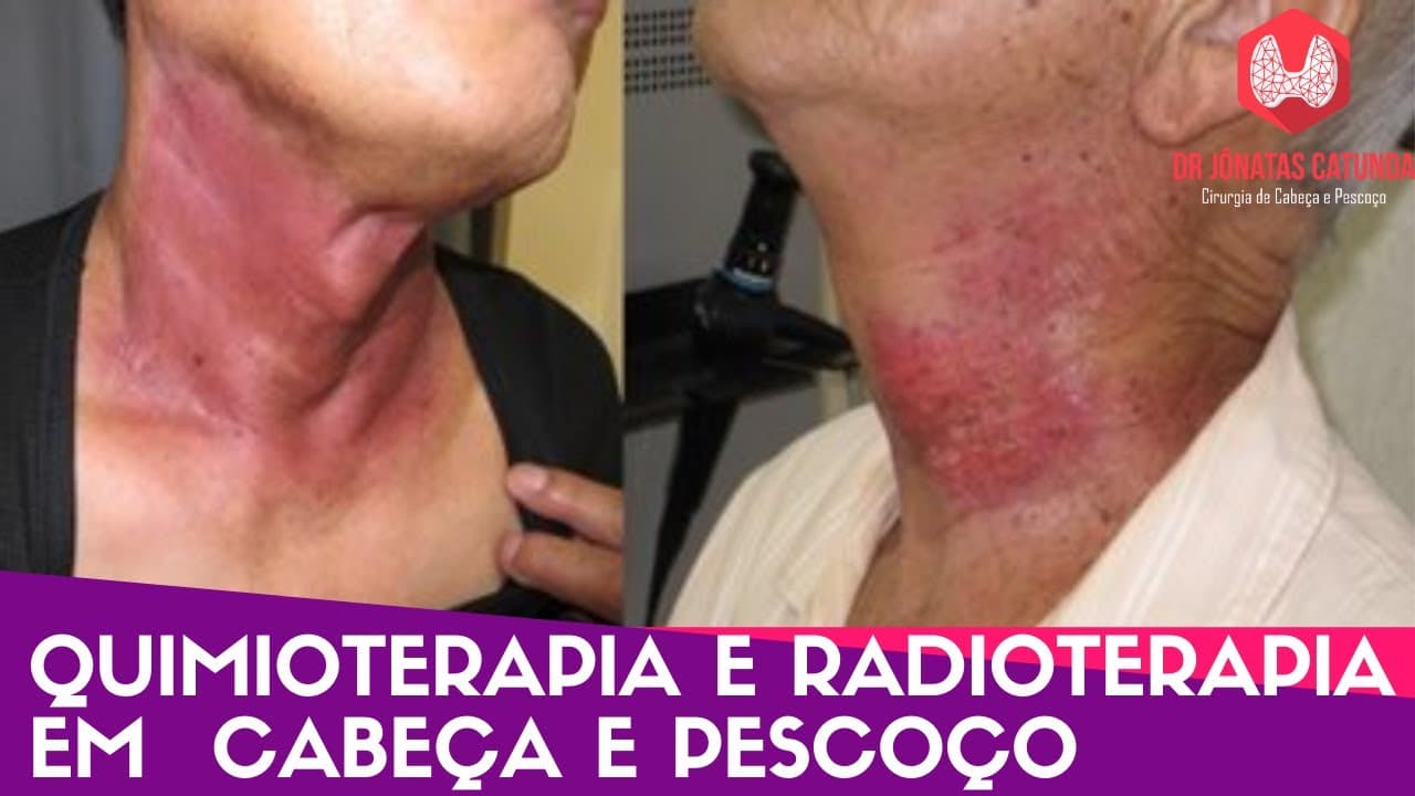 Quimioterapia e radioterapia em cabeça e pescoço
