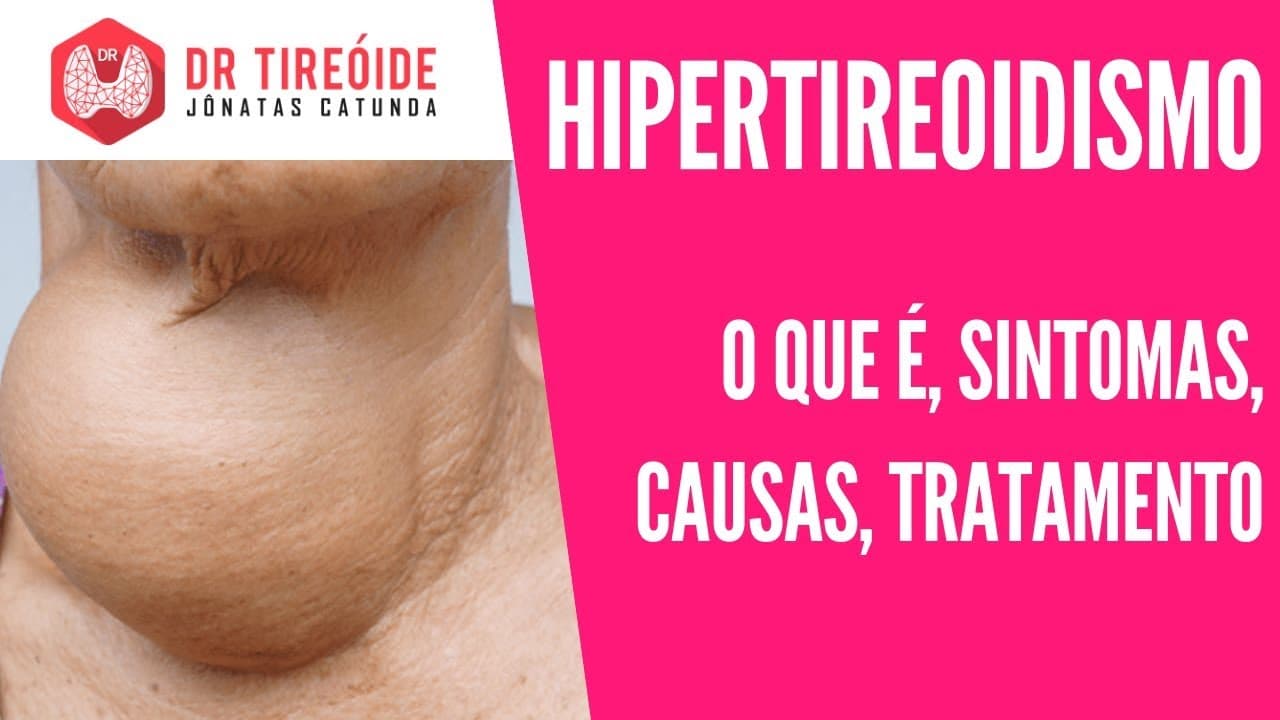 Hipertireoidismo - O que é? Sintomas ? Causas? Tratamento? | Dr Jônatas Catunda