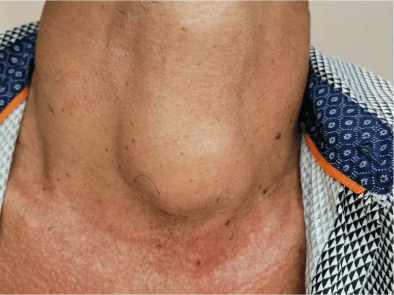 Bócio da Tireoide: Volume Normal, Tabela cm³ e Causas | Guia 2026