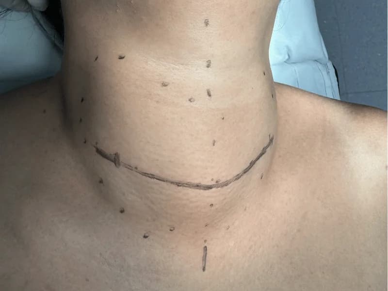 Bócio Tóxico: Nódulos Que Produzem Hormônio | Guia 2026