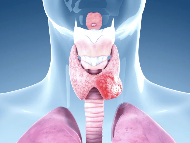 5 Fatos Sobre Câncer de Tireoide | Guia 2026