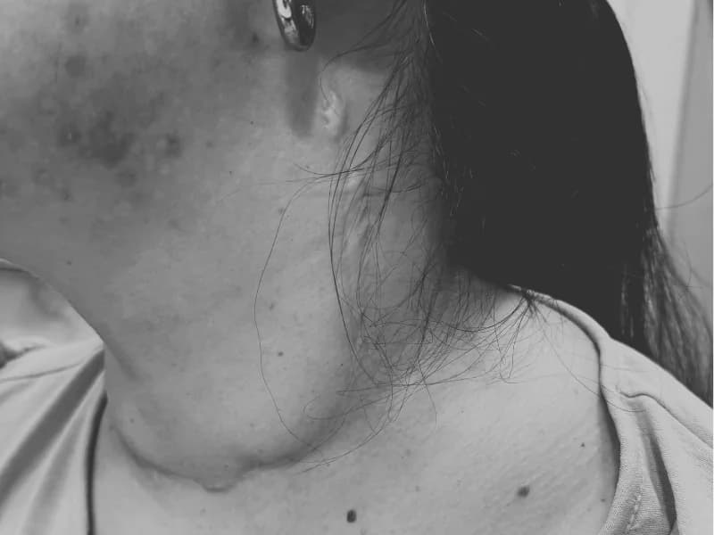 Esvaziamento Cervical no Câncer de Tireoide: Quando é Necessário?