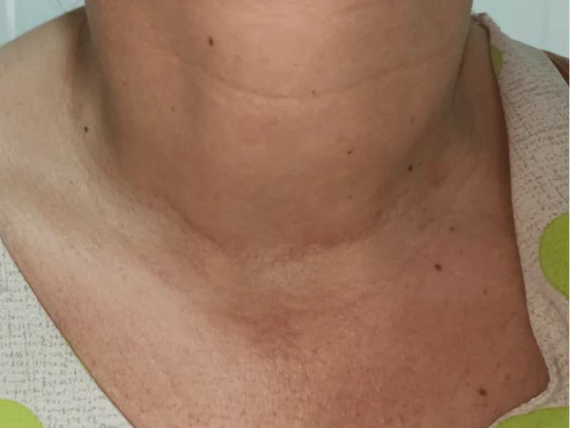 Medo de Ficar Sem Voz Após Cirurgia de Tireoide: o Que é Real e o Que é Mito