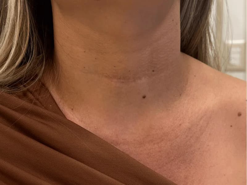 Consequências da Cirurgia de Tireoide: O Que Muda na Sua Vida | 2026