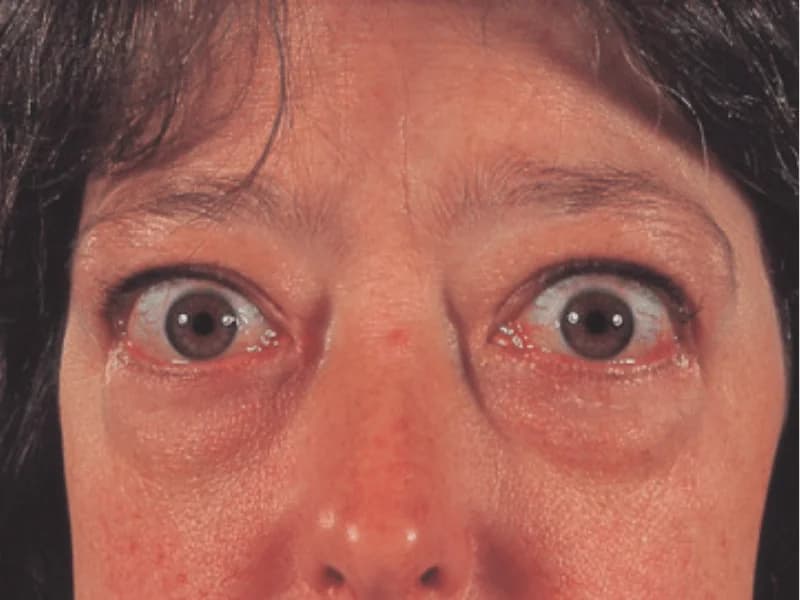 Doença de Graves: Olhos Saltados, Sintomas e Tratamento | Guia 2026