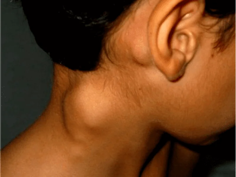 Câncer de Tireoide com Metástase: O Que Isso Muda no Tratamento