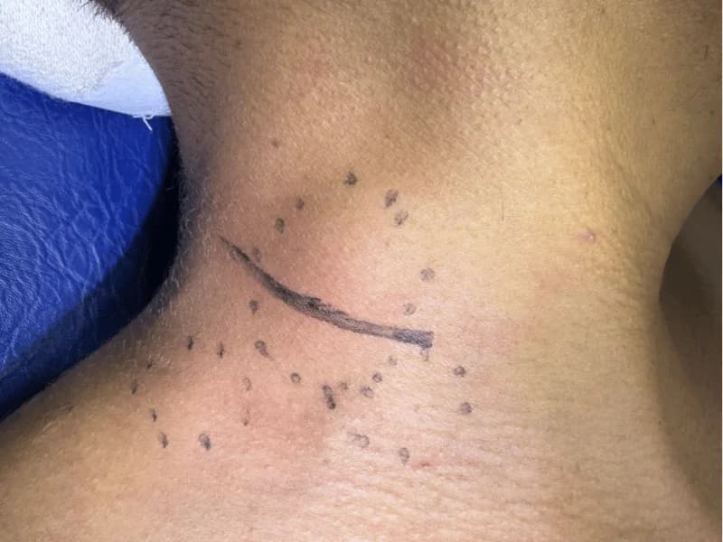 Linfonodo Reacional: O Que É, Causas e Quando Se Preocupar | 2026