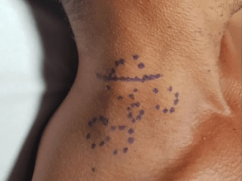 Linfonodo Reacional Tratamento: Como Tratar e Quando É Necessário | 2026