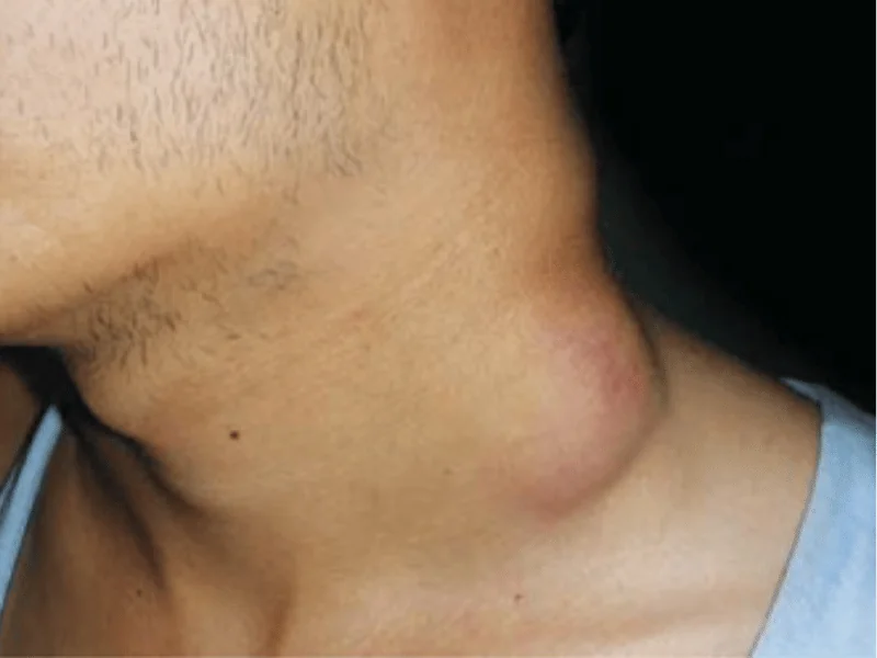 Linfonodos no Pescoço Quanto Tempo Dura: Guia Completo | 2026