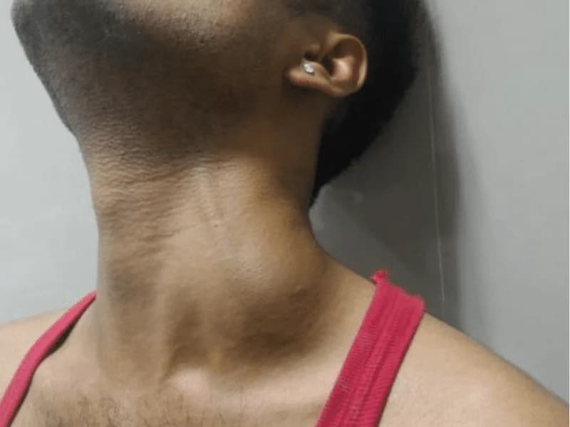 Linfonodo Cervical Aumentado: Causas Benignas e Sinais de Alerta | 2026